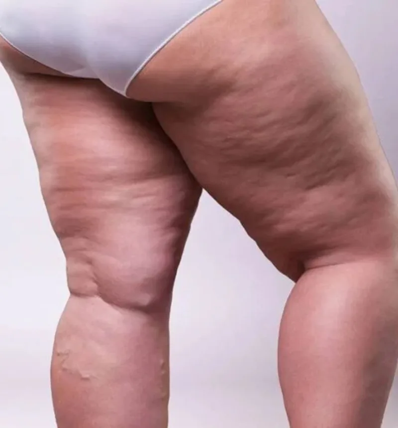 Tratamento de lipedema
